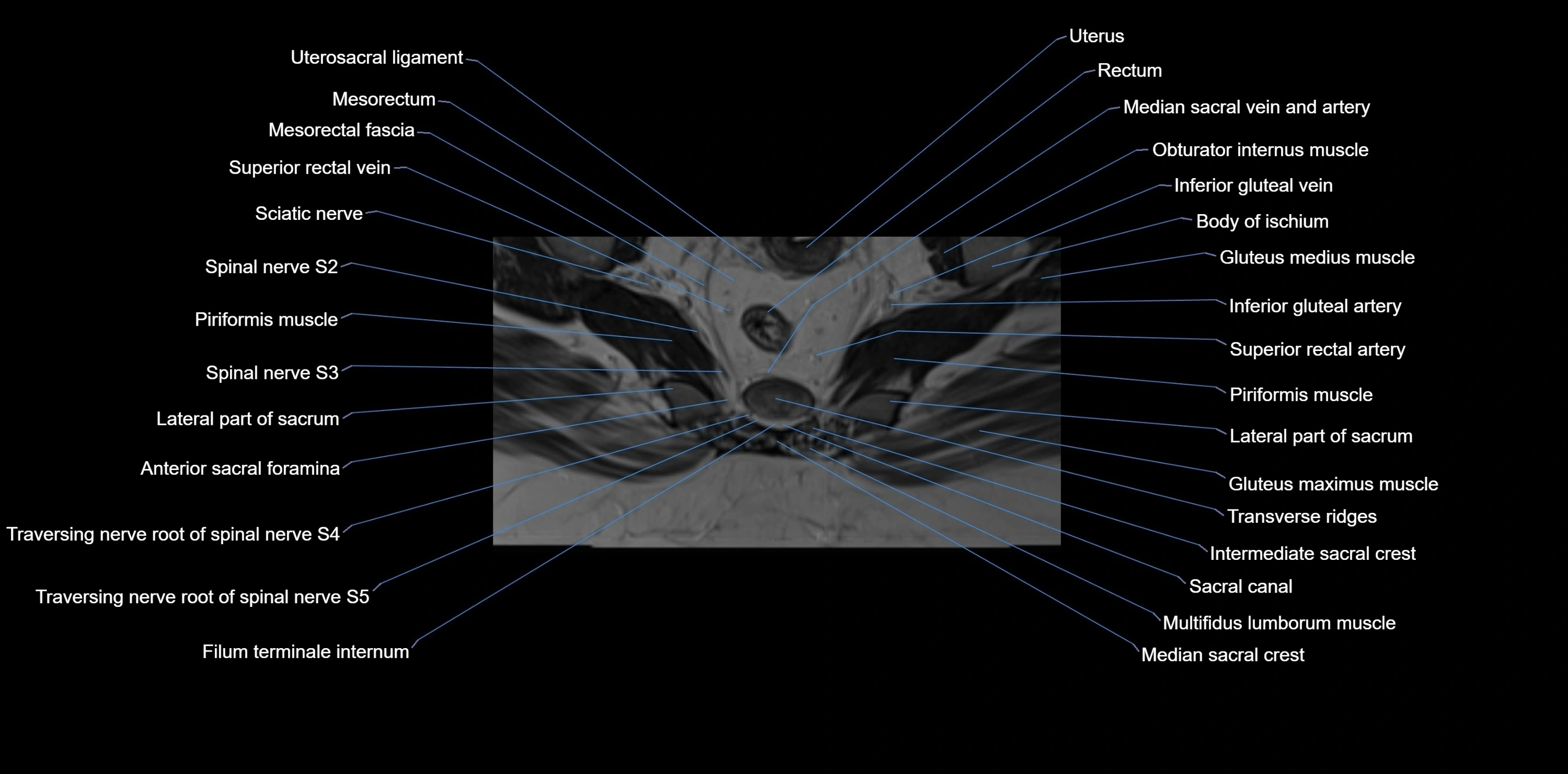 MRI sacrum, coccyx and sacroiliac joint axial cross sectional anatomy 3T  radiology  image-img-00001-00044.webp